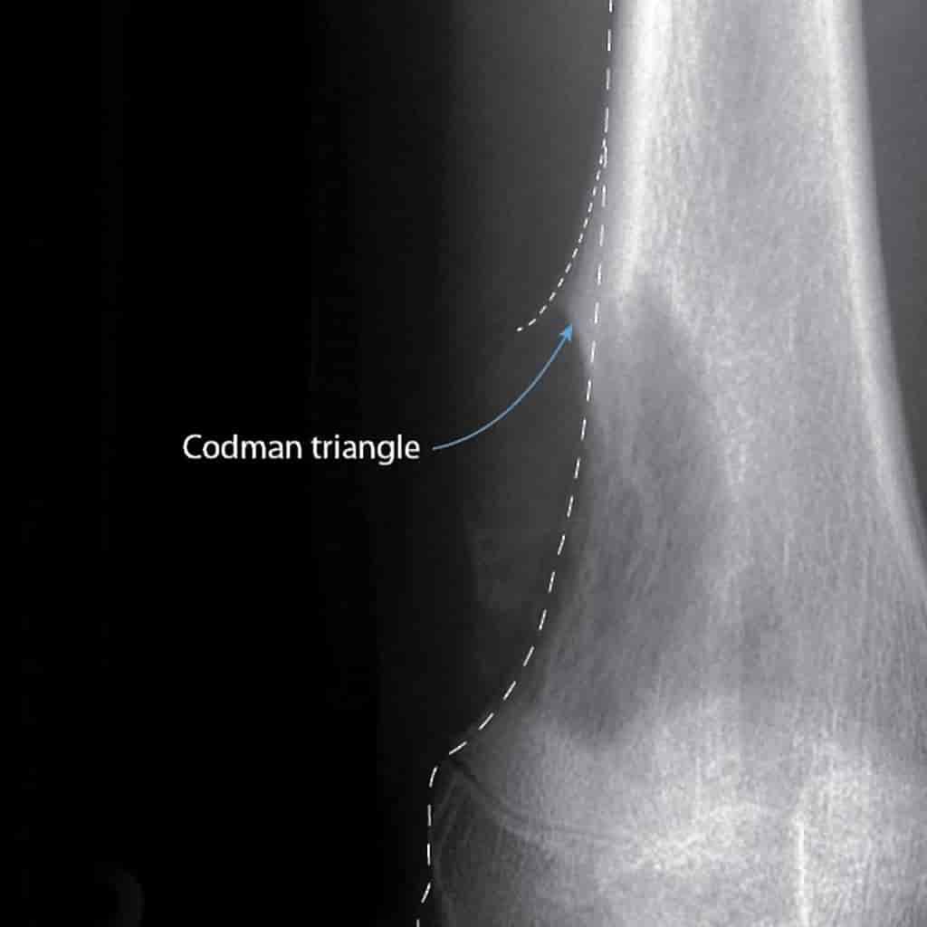 Røntgenbilde ved kneet viser løftet beinhinne som følge av ondartet svulst i lårbeinet (mørkt område)