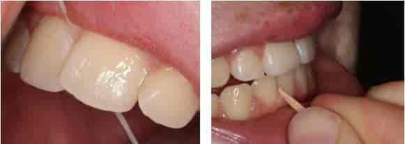 Rengjøring mellom tennene