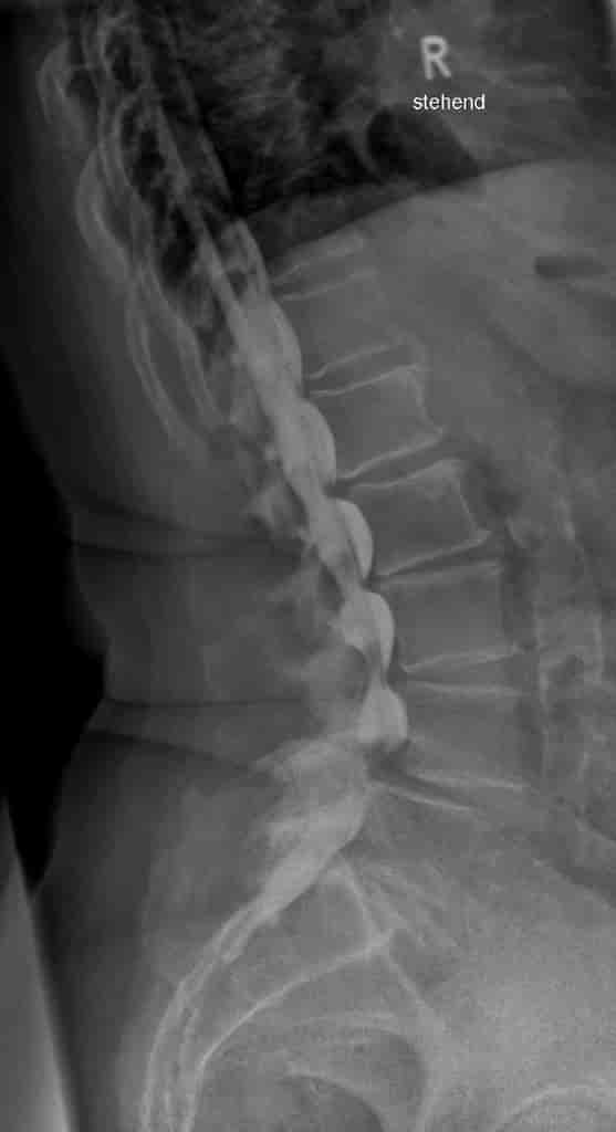 Myelografiundersøkelse av en 75 år gammel dame med ryggproblemer viser trang spinalkanal (avsmalning i høyde med mellomvirvelskivene) i  flere nivåer på grunn av degenerative forandringer.