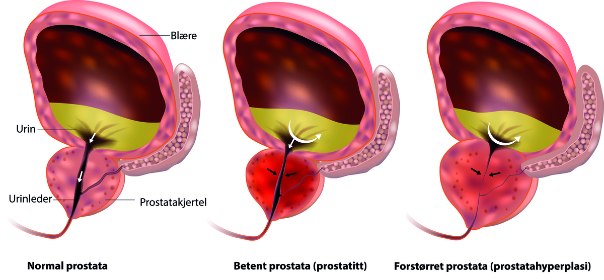 A prosztatitis különbsége urethritisből)