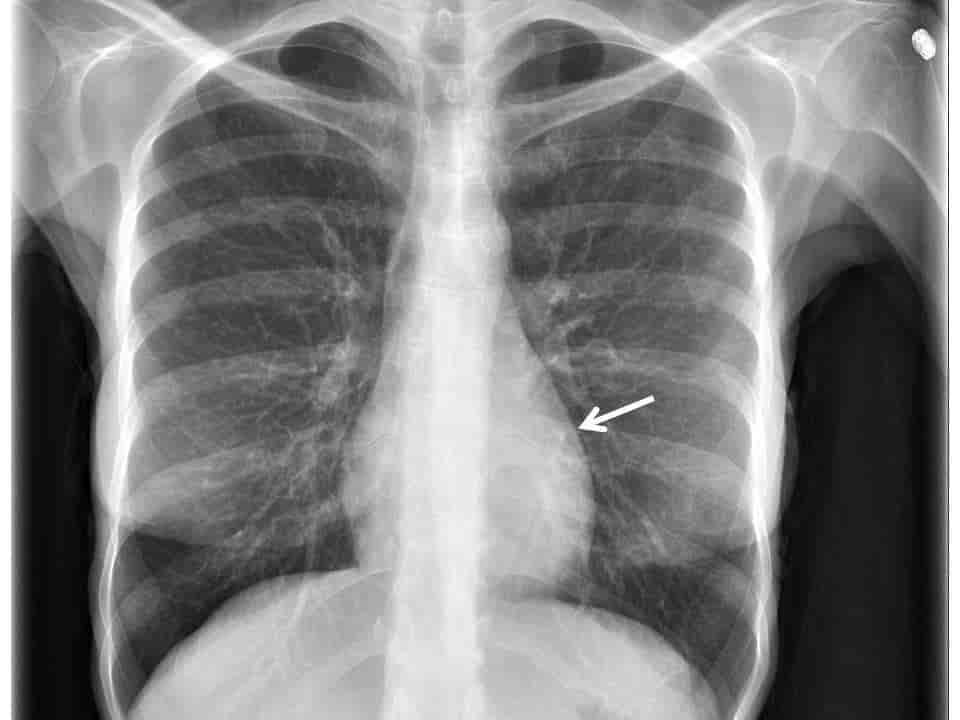 Røntgenbildet viser et tilsynelatende lite og dråpeformet hjerte (pil) hos en mager pasient med anoreksi.
