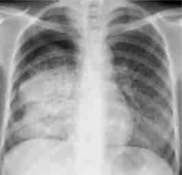 Lungetuberkulose