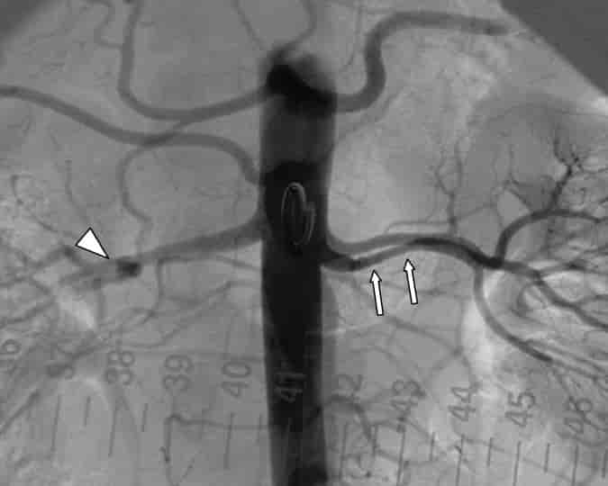 Renal arteriografi