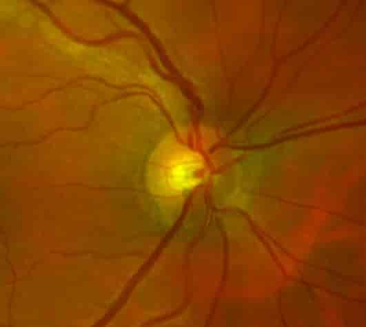 Det gule omtrådet er synsnervehodet. Ut fra dette slynger det seg flere blodårer utover netthinnen. 