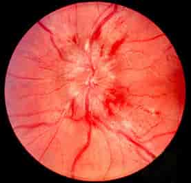 Oftalmoskopi av stasepapille der synsnervehodet (papillen) er svullen med uskarp avgrensning og flere blødninger. 