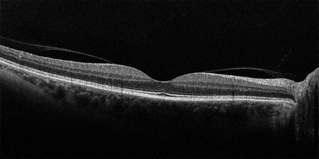 Snittbilde av normal makula tatt med teknikken optical coherence tomography (OCT).
