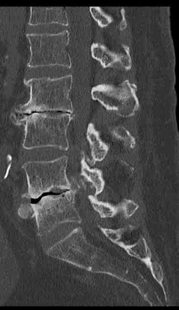 Spinal Osteokondrose