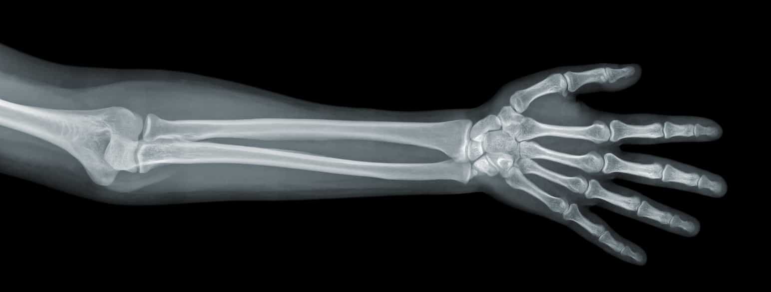 Røntgenbilde av underarmen og hånden