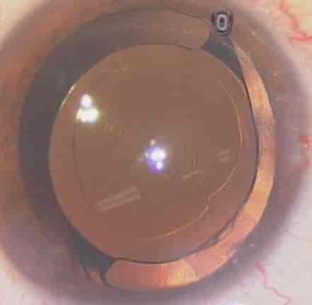 Multifokal linse beliggende i den gamle linsekapselen i øyets bakre kammer. Pupillen er maksimalt utvidet med øyedråper.