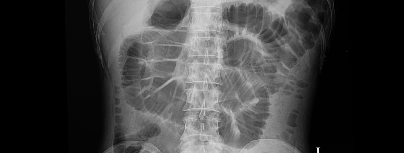 Røntgenbilde av pasient med mekanisk ileus - tallrike tarmslynger utspilt av luft.