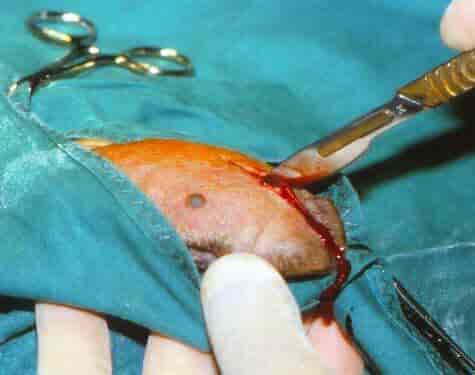 Kirurgisk behandling. innsnitt for fjerning av blod