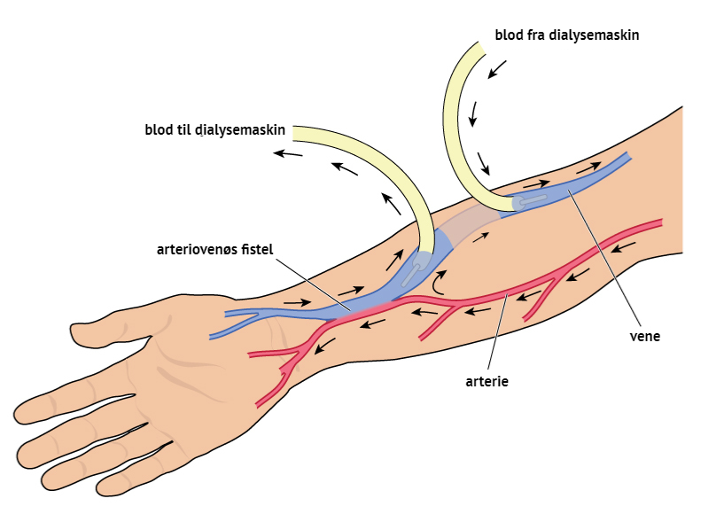 Arteriovenøs fistel