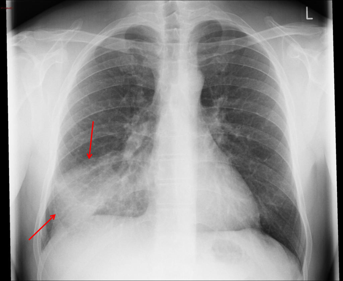 Røntgenbilde av lungebetennelse