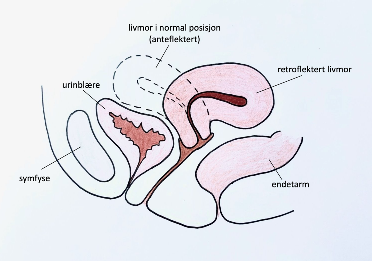 retroflextio uteri