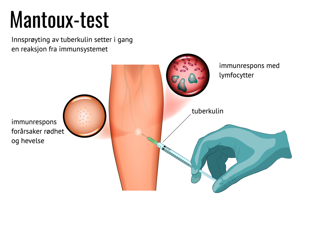 Mantoux-test