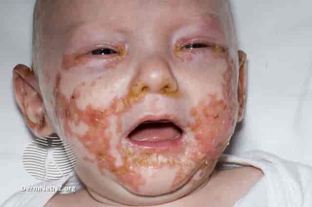 Typisk utslett hos et spedbarn med acrodermatitis enteropathica