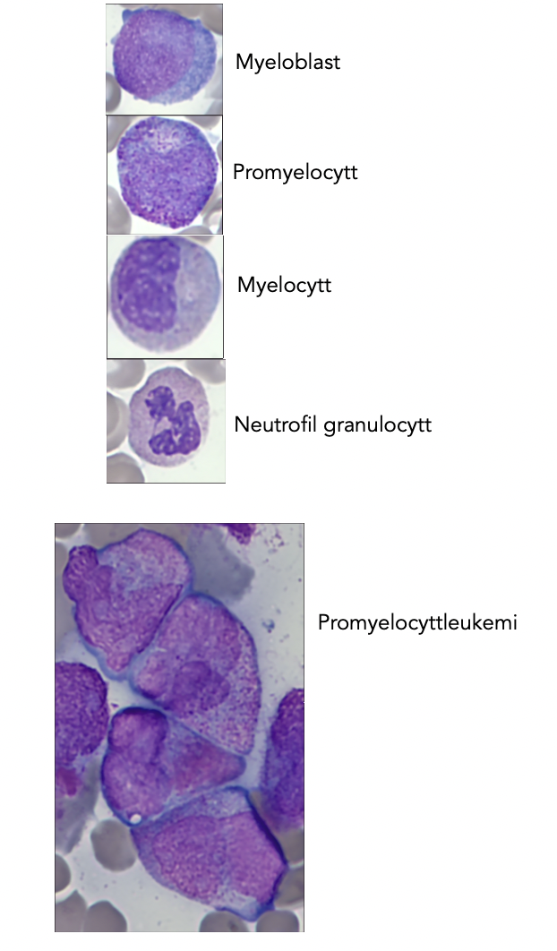 Myelopoiesen og promyelocyttleukemi