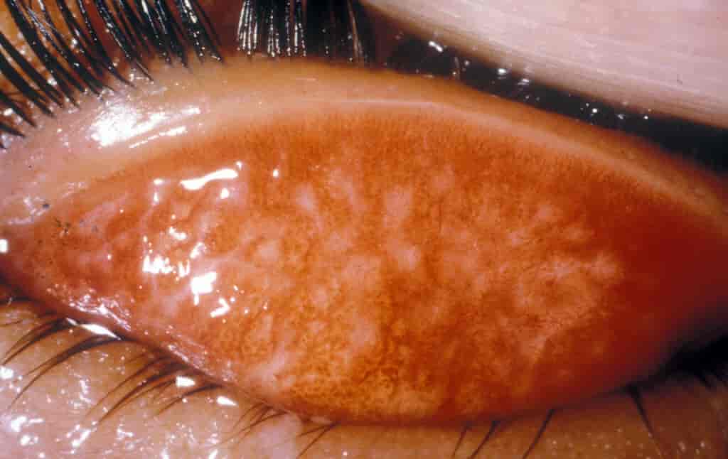 Follikler på øvre øyelokks bindehinne (follikulær fase)