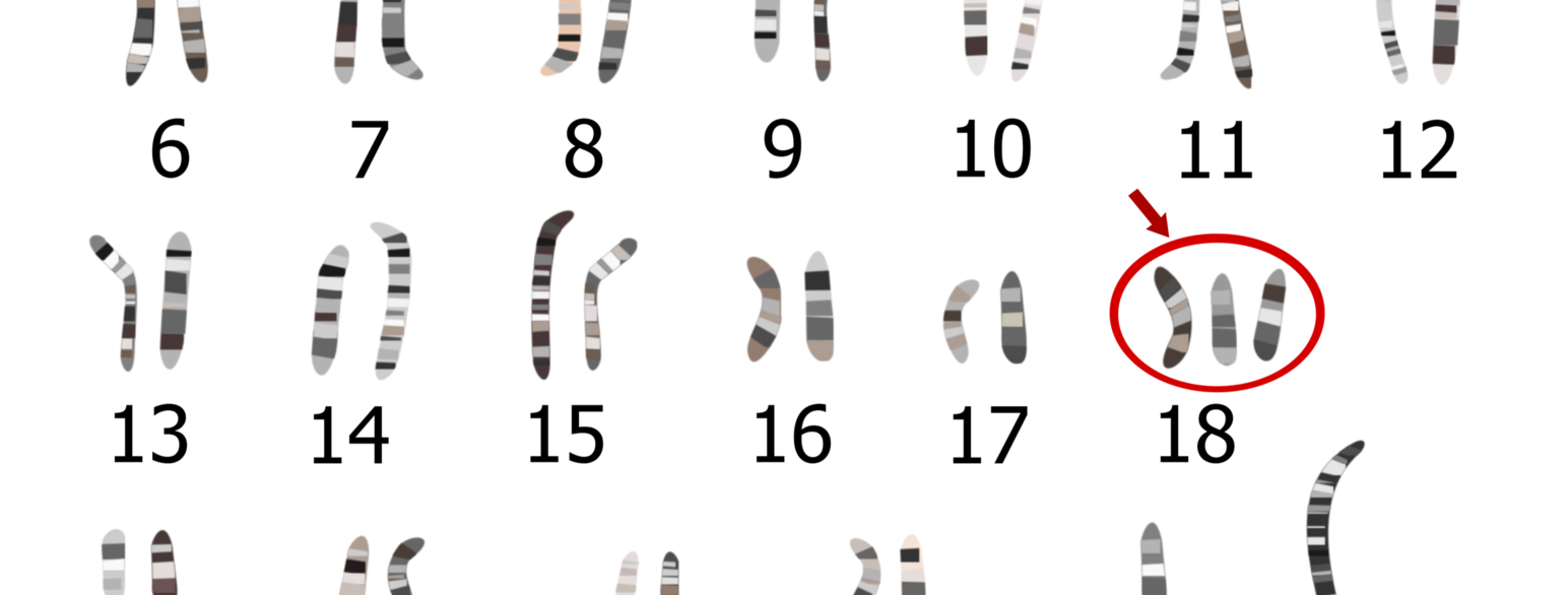 Trisomi 18 som gir Edwards syndrom er et eksempel på kromosomavvik
