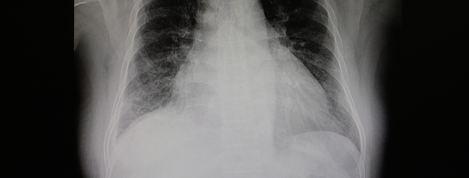 Røntgenbilde av brystkassen til en  person med hjertesvikt kan vise blant annet et forstørret hjerte og stuvningsforandringer i lungene.