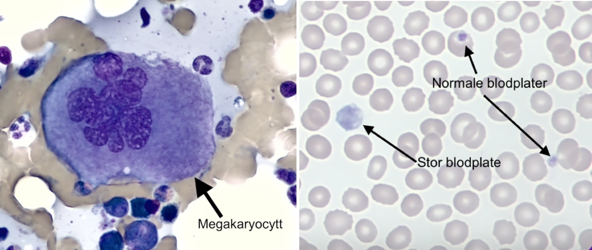 Blod og beinmerg ved immunologisk trombocytopeni