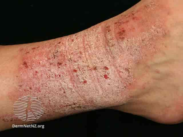Lichen simplex, med kroniske forandringer av huden som skyldes langvarig kløing