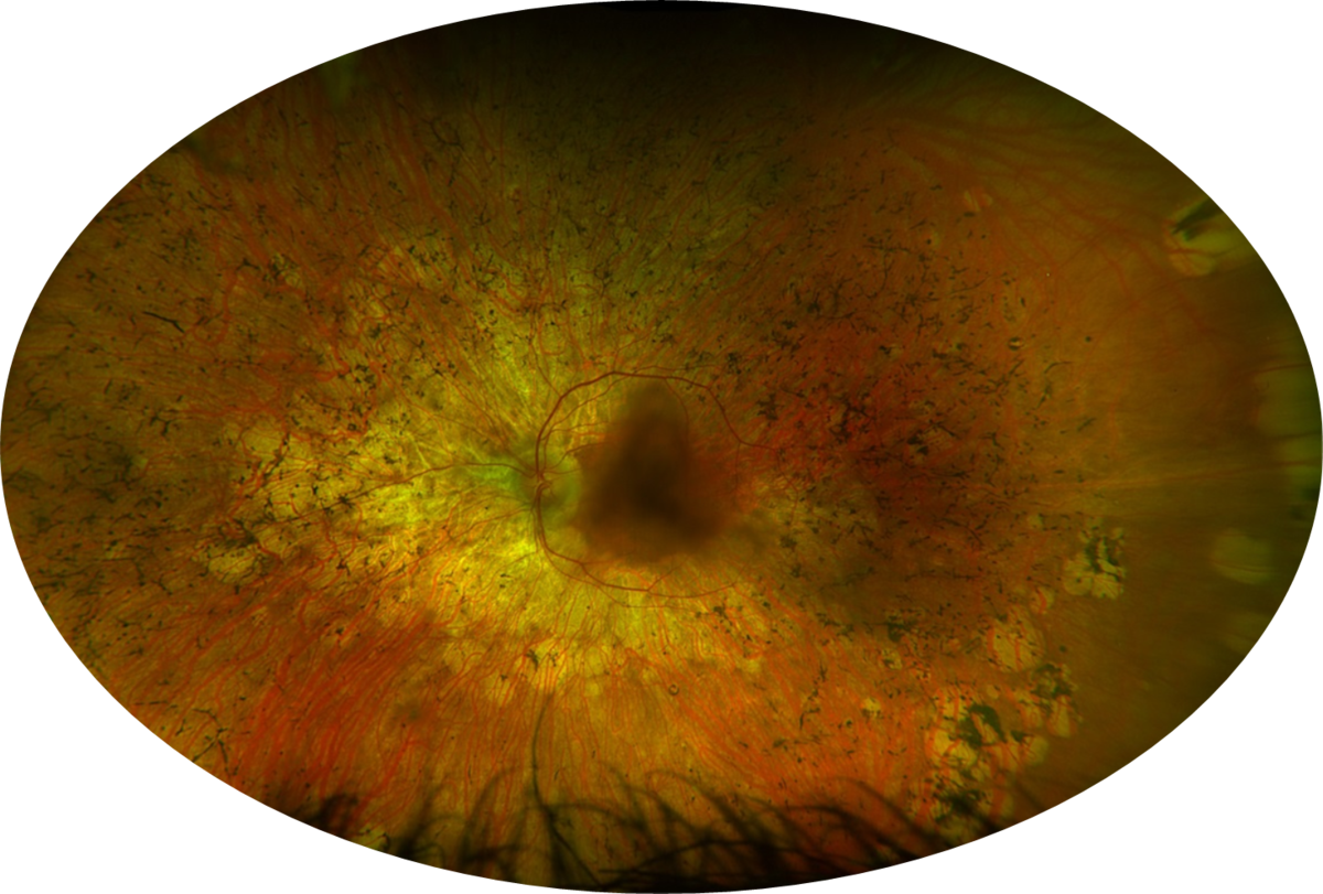 Netthinne med retinitis pigmentosa