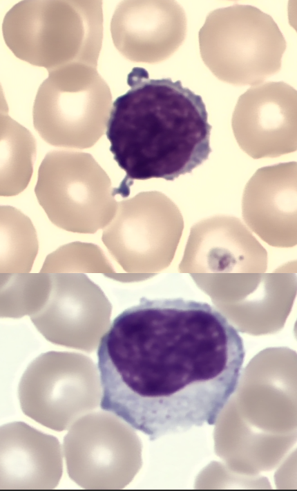 Lymfocytter i blod
