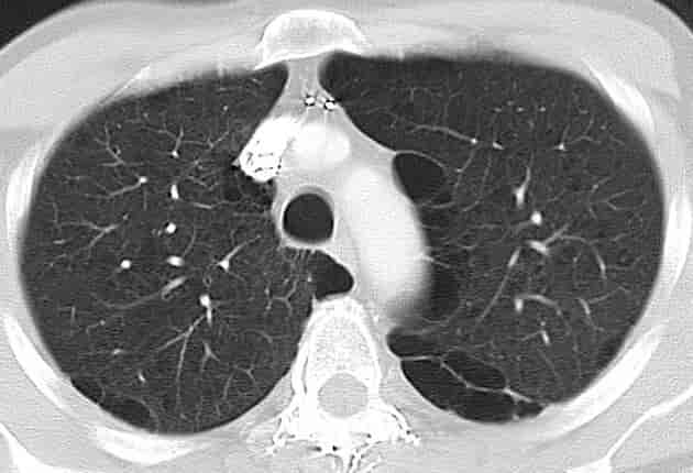 CT av lungene