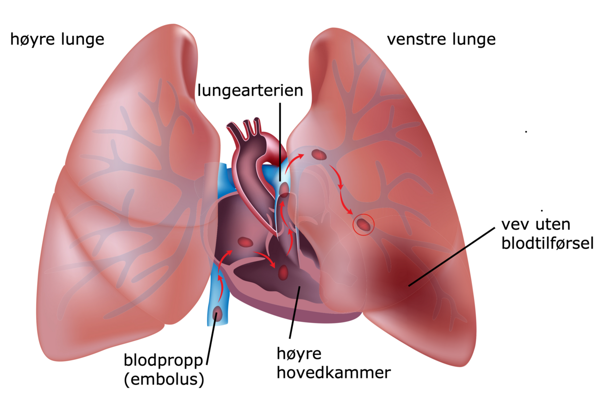 Lungeembolisme