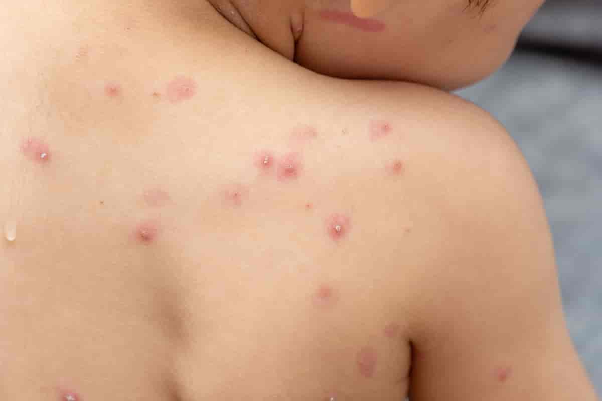 Et barn med røde prikker over ryggen. Prikkene er røde med hvite prikker inni, et klassisk tegn på vannkopper. 