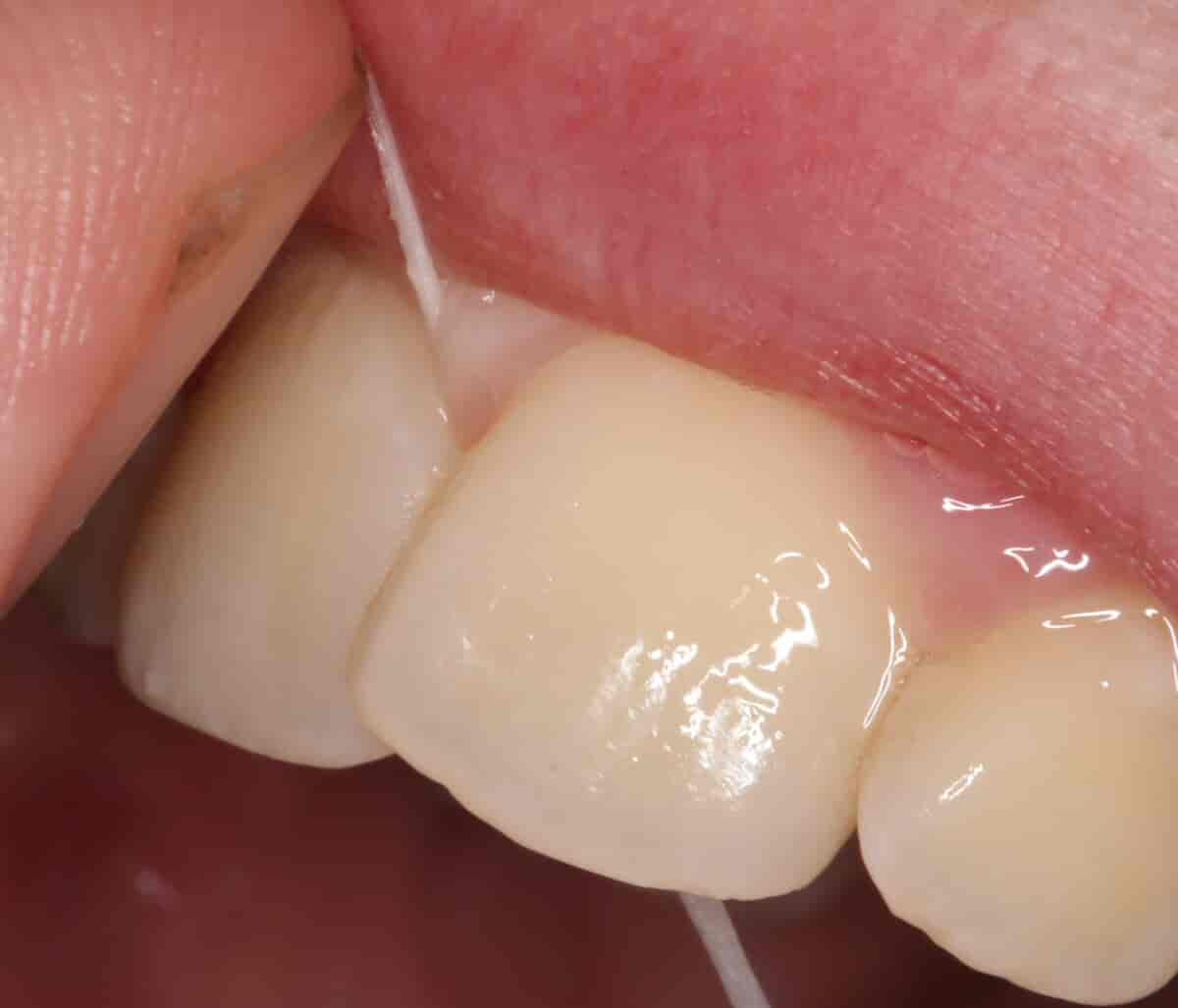 Tanntråd i tannkjøttlomme
