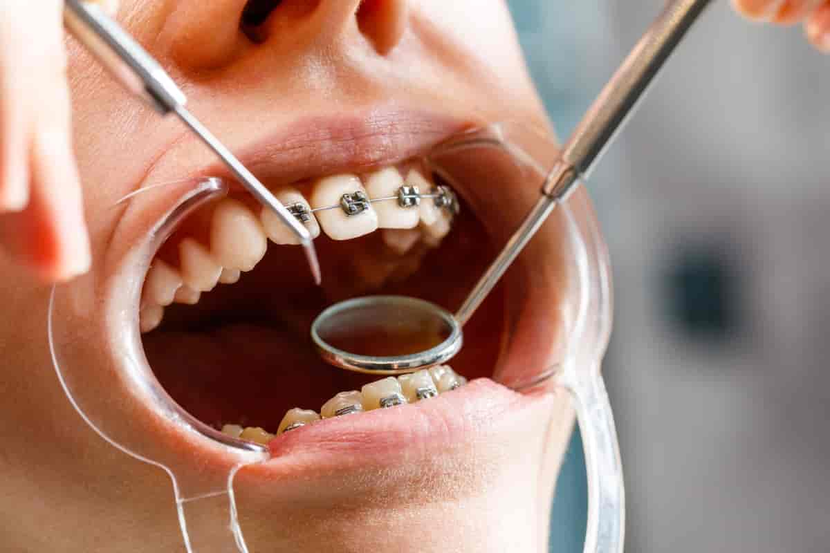 Foto av kvinne med tannregulering som blir undersøkt i munnen.