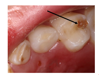 Foto av tann med et brunt søkk. 