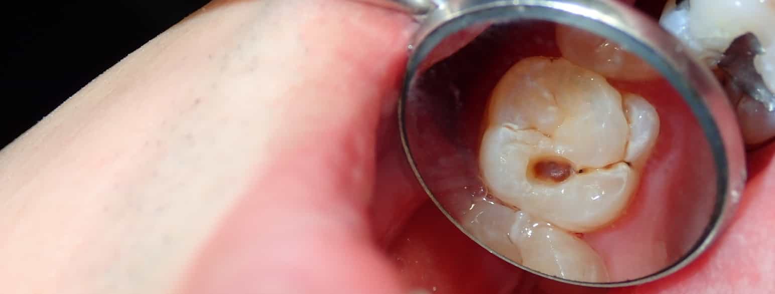 Fotografi av et tannlegespeil som viser en jeksel med en sprekk og et stort, brunt hull