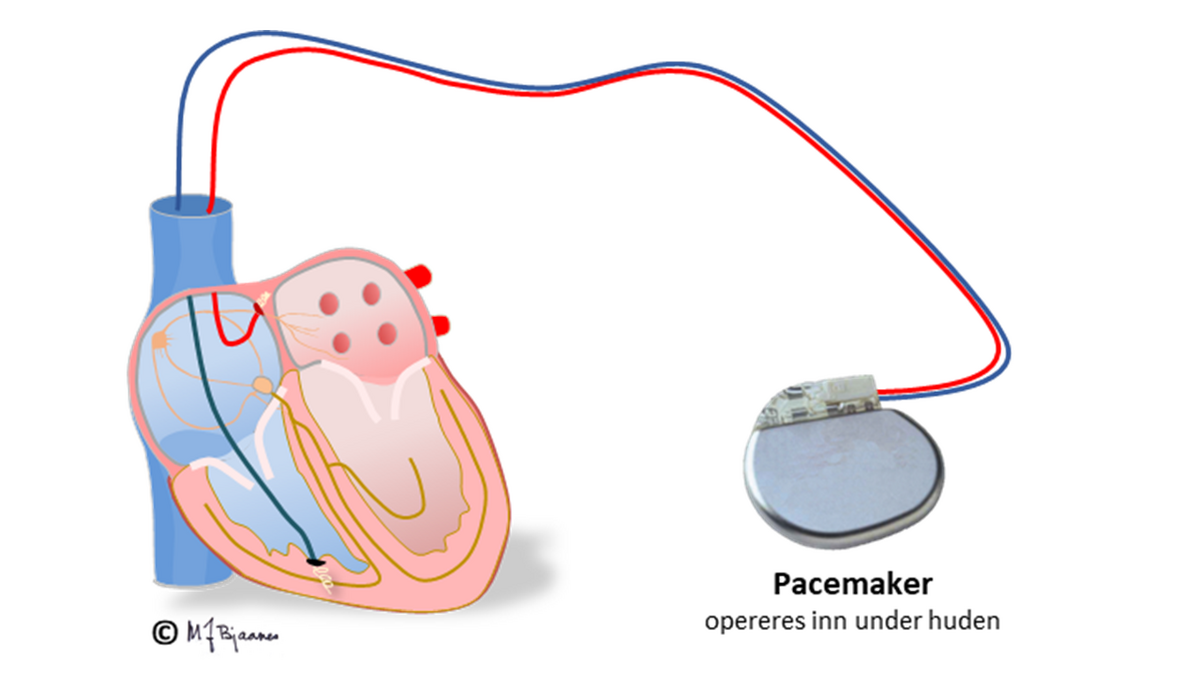 Tokammer pacemaker