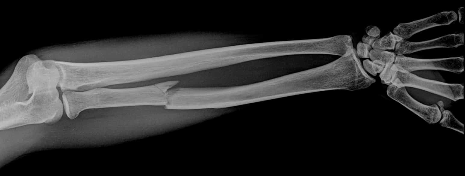 Røntgen av et brukket bein i armen