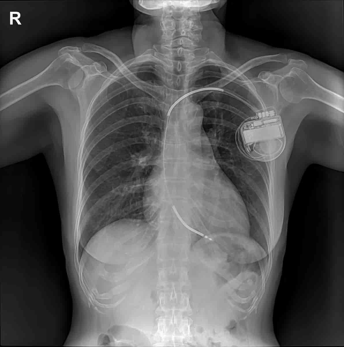Røntgenbilde av brystet med ICD