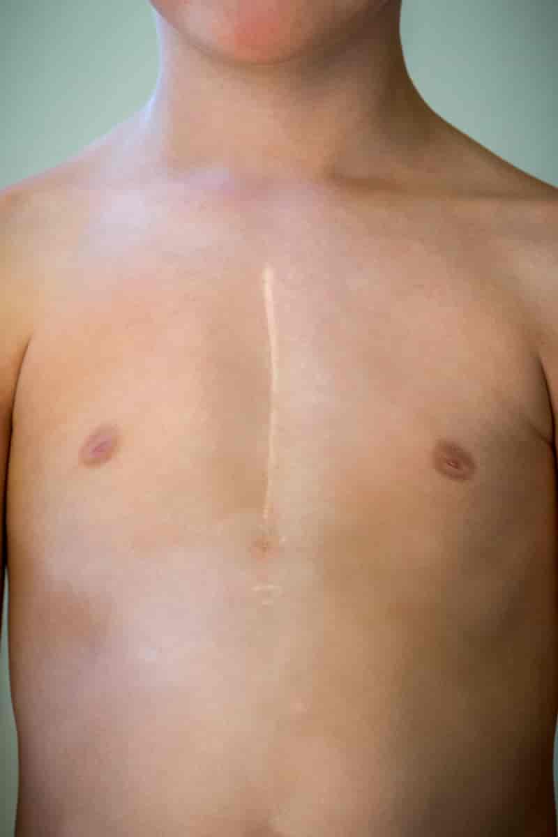 Ein ung mann med ein kvit, rett strek som er lysare enn resten av huda. Arret er 10-15 centimeter langt og er plassert midt mellom brystvortene. 