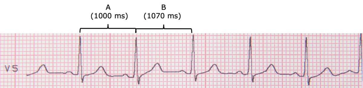 Bildet viser en EKG-stripe som måler den elektriske aktiviteten i hjertet. For hvert hjerteslag er det en høy takk (R-takken). Det er satt opp et mål A mellom de to første R-takkene, og et nytt mål (B) mellom de to neste R-takkene. Det er en liten forskjell i lengde mellom dem. 
