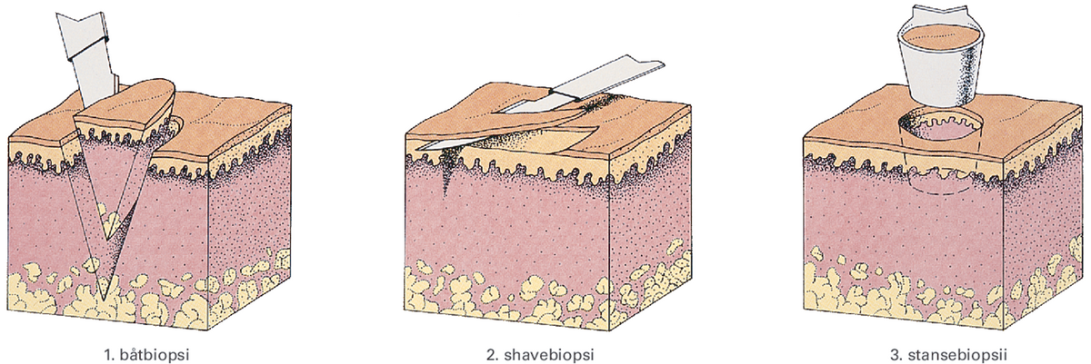 Illustrasjonen består av tre deler. Første illustrasjon viser hud som blir skåret i med kniv ganske dypt ned i huden. Dette kalles båtbiopsi. Andre illustrasjon viser en kniv som skjærer overfladisk i huden. Dette kalles en shavebiopsi. Tredje illustrasjon viser en sylinder som skjærer rett ned i huden og etterlater et sirkelrundt sår. Dette kalles stansebiopsi.