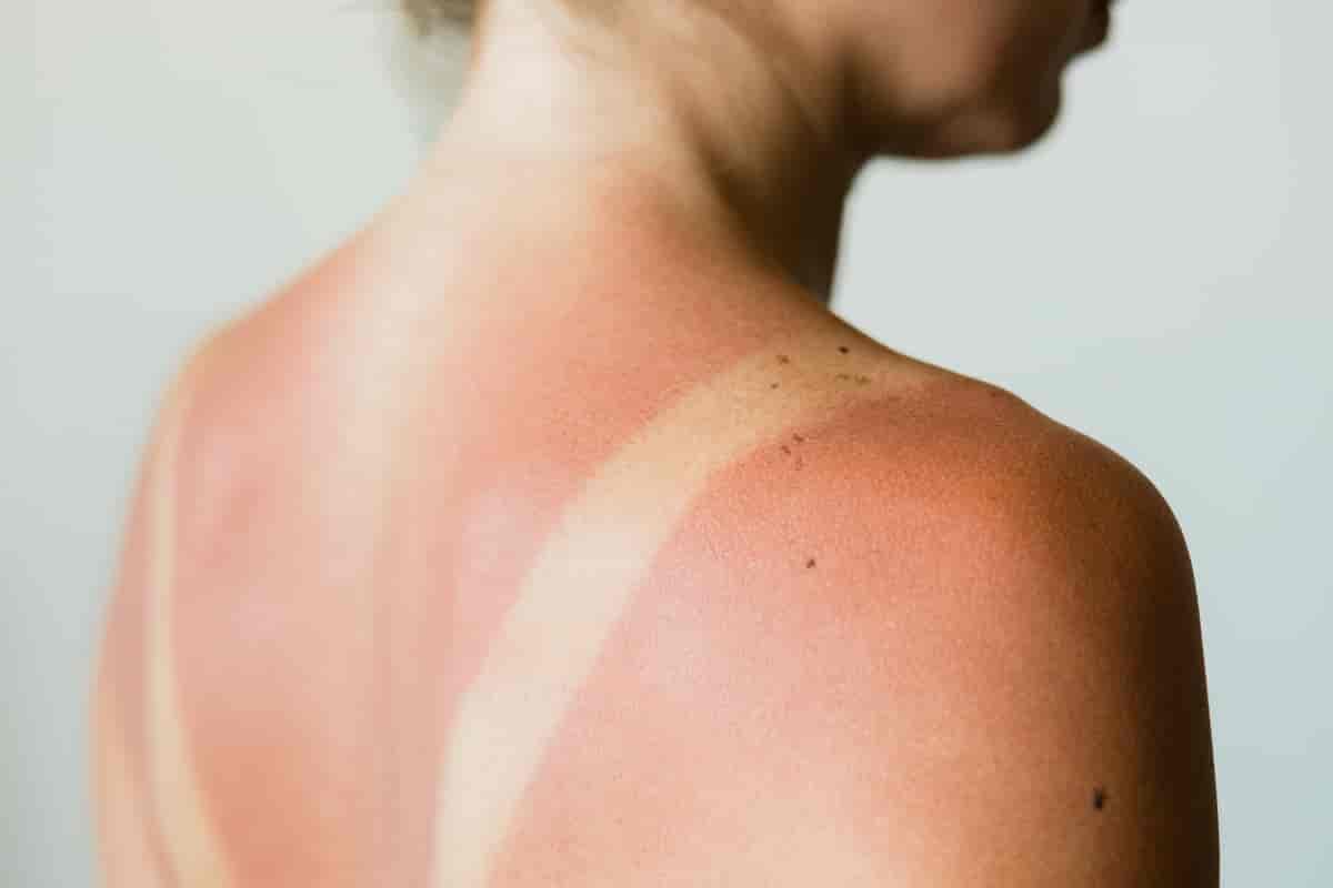 Fotografi av en kvinnes rygg og skulder. Huden er rødfarget på grunn av solforbrenning, unntatt der BH-stroppene har vært. Der er huden lys og frisk. 