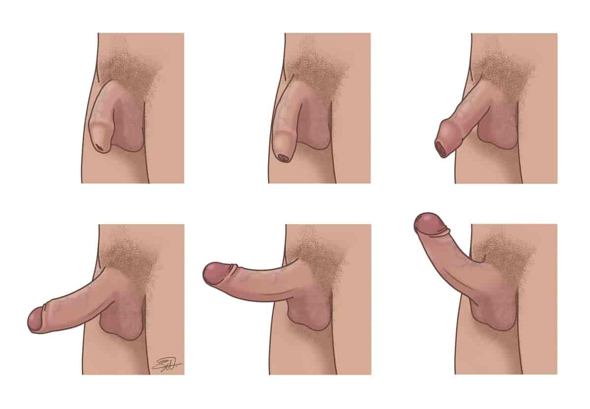 Seks tegninger viser en penis gå fra slapp til erigert tilstand. Først henger penis slapt ned, og etter hvert blir den tykkere og lengre. Forhuden trekkes gradvis tilbake. I det siste bildet er penis stiv og peker diagonalt oppover.