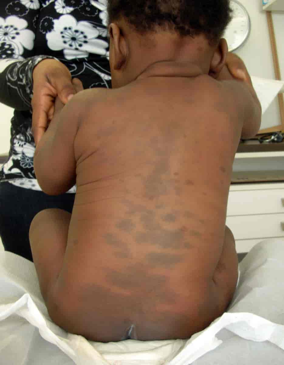 Lite barn med medfødt dermal melanocytose på ryggen