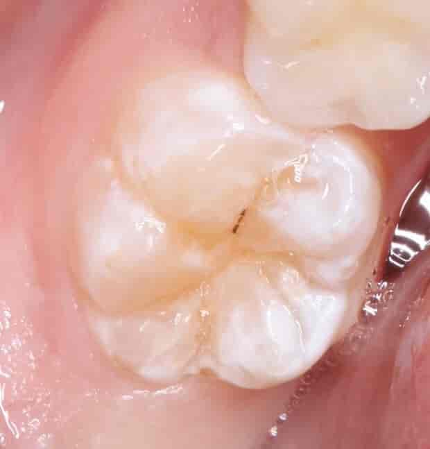 Mild dental fluorose