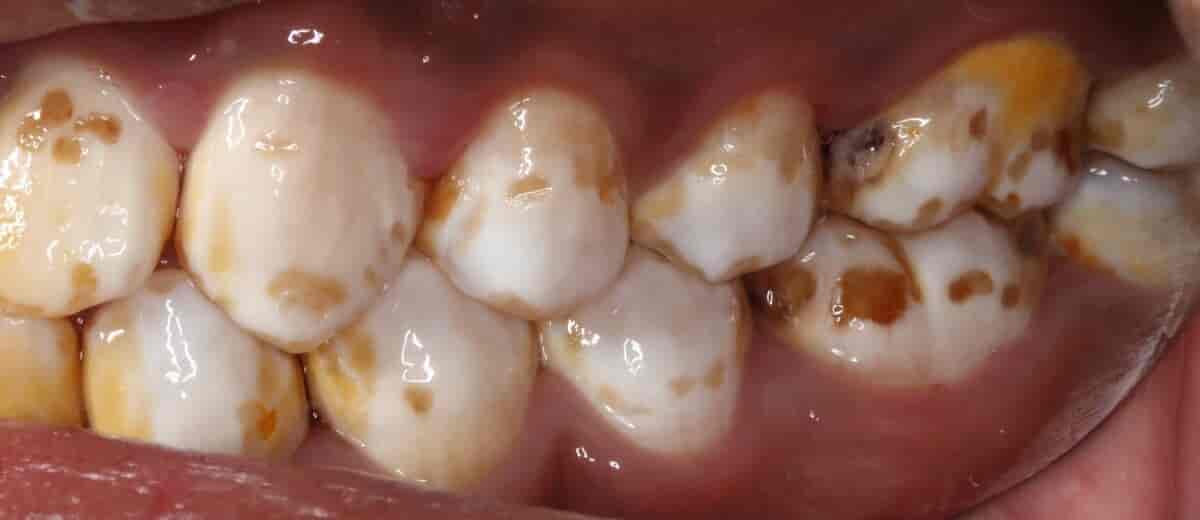 Alvorlig dental fluorose