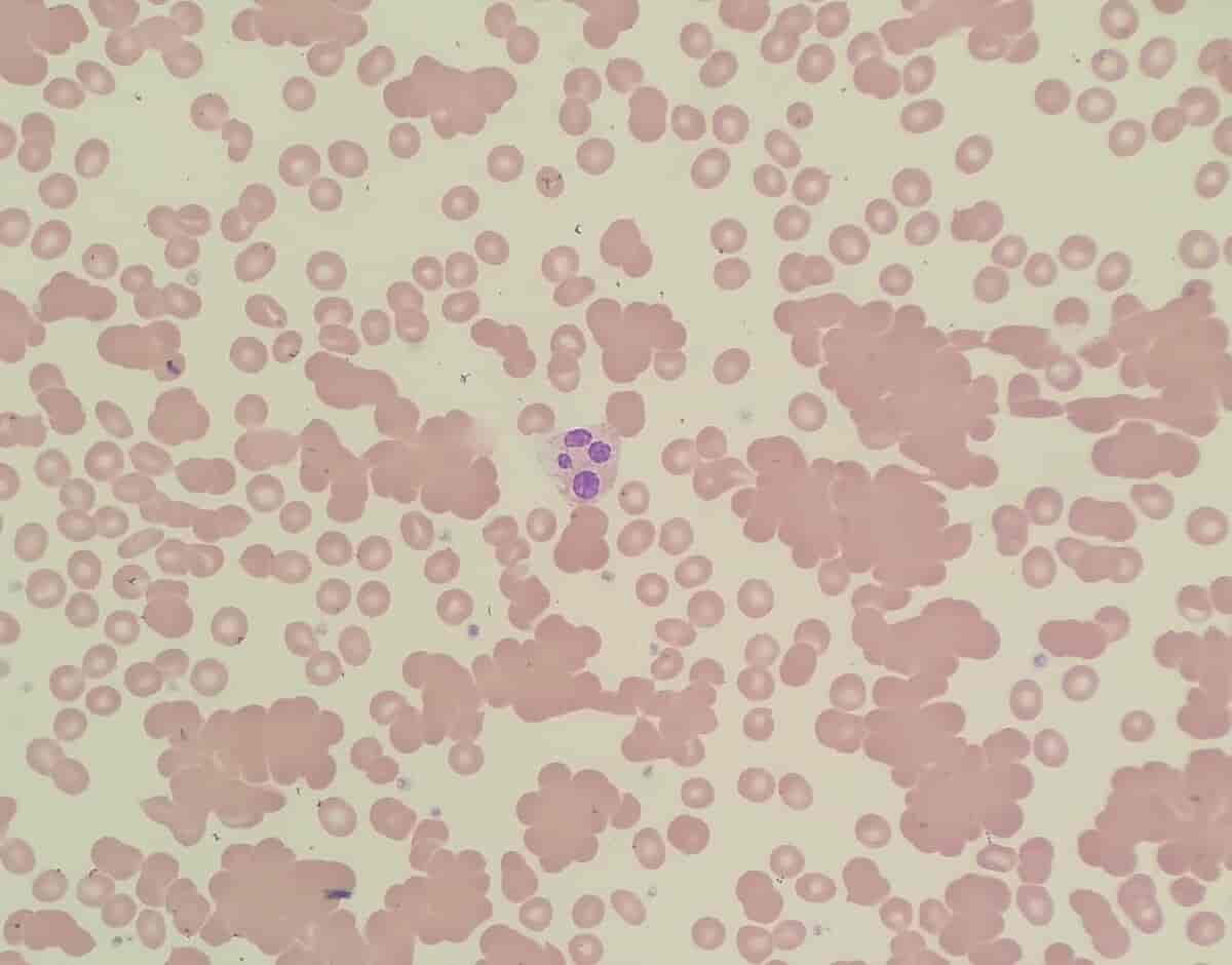 Agglutinasjon av røde blodceller