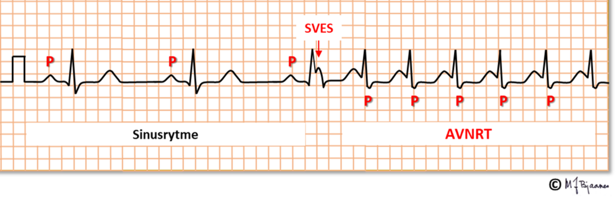 EKG-stripe med normal sinusrytme og AVNRT