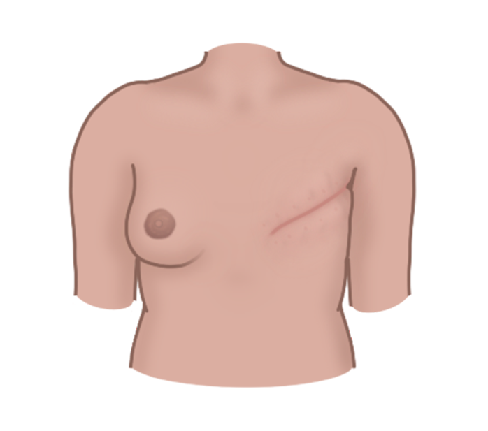 En overkropp hvor ett bryst er blitt operert bort på grunn av brystkreft. Det er et rosa og skrått arr fra armhulen til midt på brystkassen.