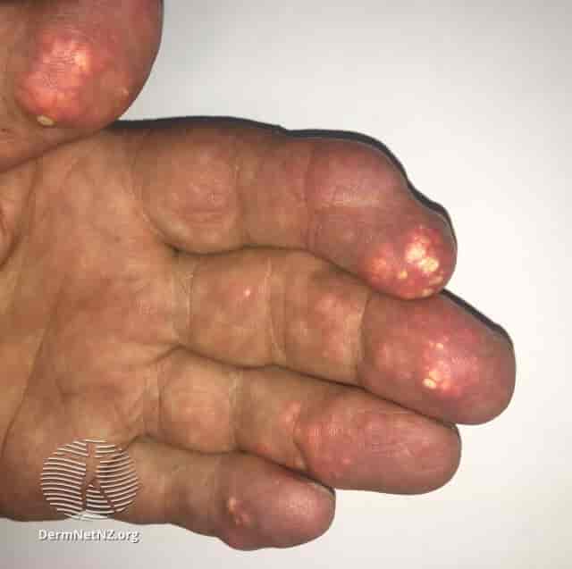 Tofi i fingertupper hos en person med urinsyregikt